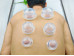 6pcs of Transparent Silicone Cupping cups, A set for stimulating 6pcs of Transparent Silicone Cupping cups, A set for stimulating